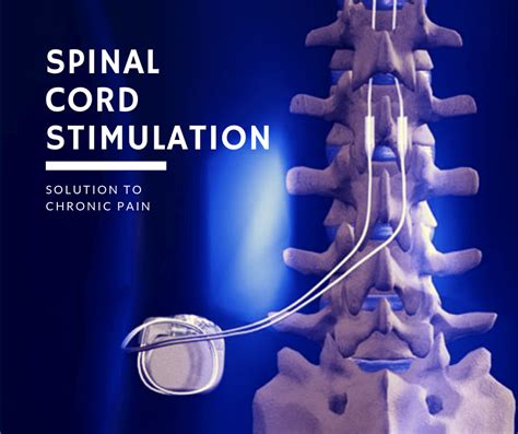 Long‐Term Spinal Cord Stimulation Alleviates Mechanical 